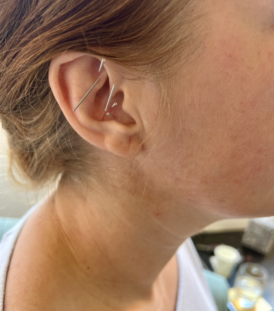Acupuncture Experience with Ellie Columbine